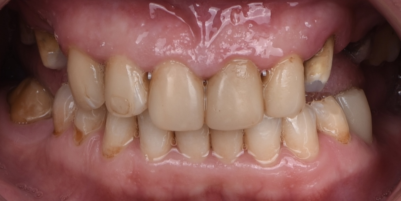 Отбеливание