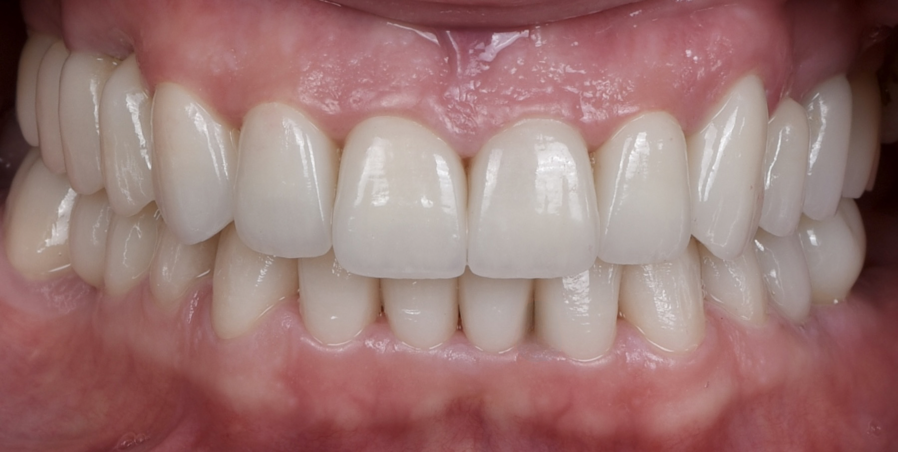 Отбеливание