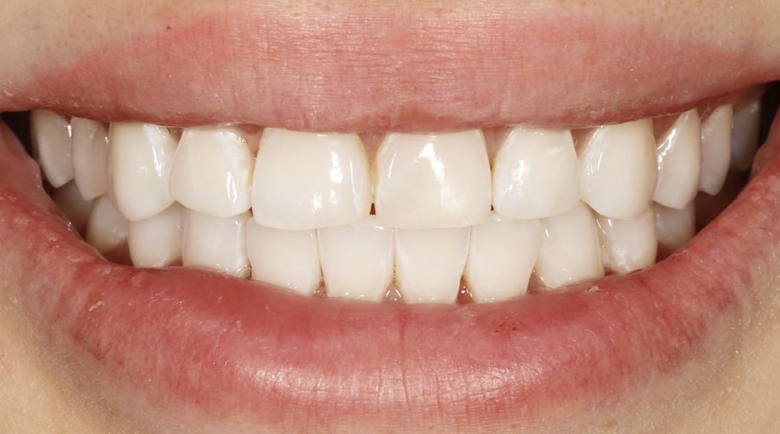 Отбеливание