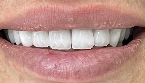 Отбеливание