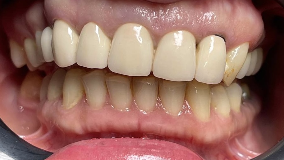 Отбеливание