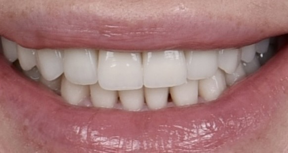 Отбеливание