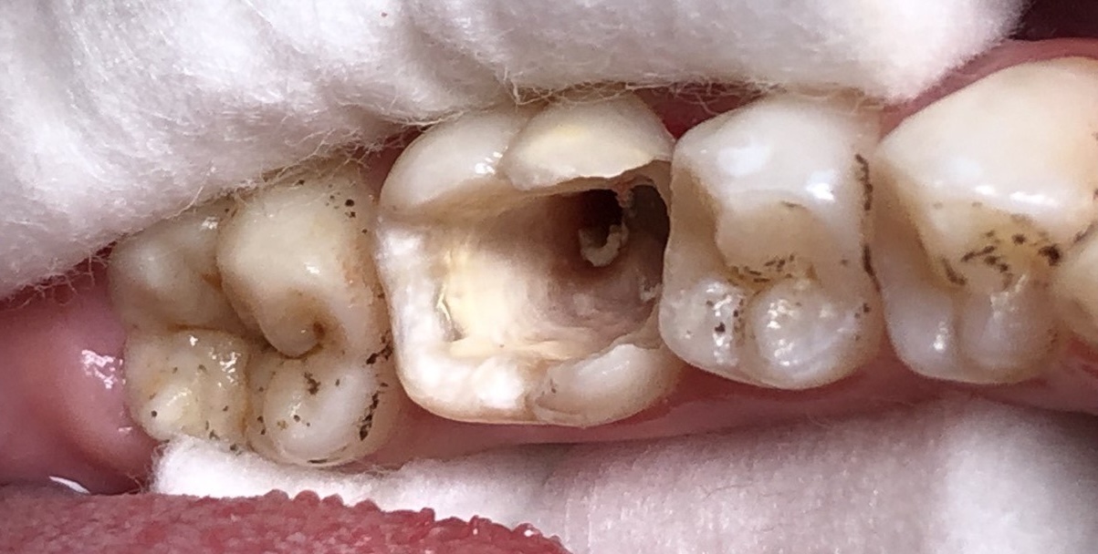 Восстановление со стекловолокном