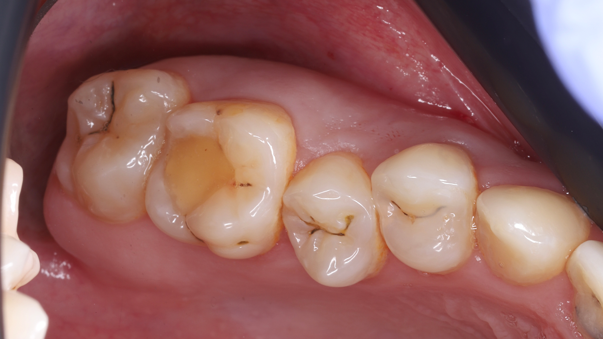 Отбеливание